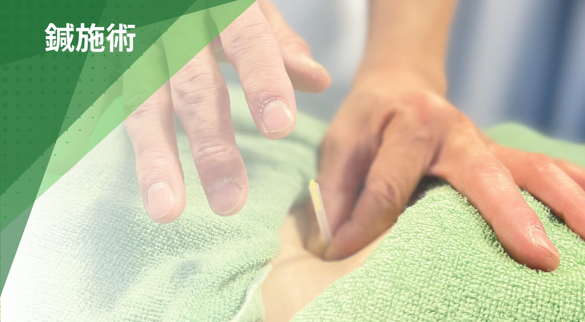 筋肉のコリや痛みに対して行う鍼施術（はり治療）の様子